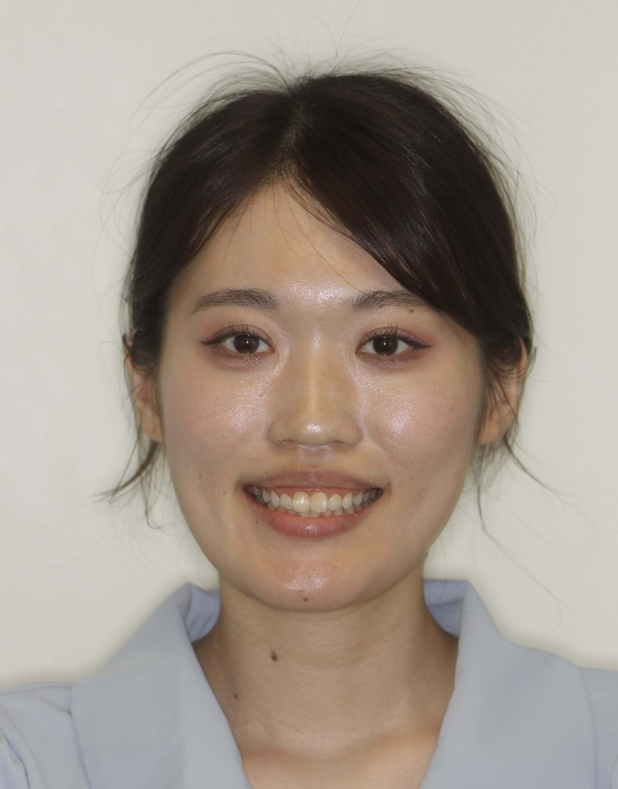 手術前・矯正前