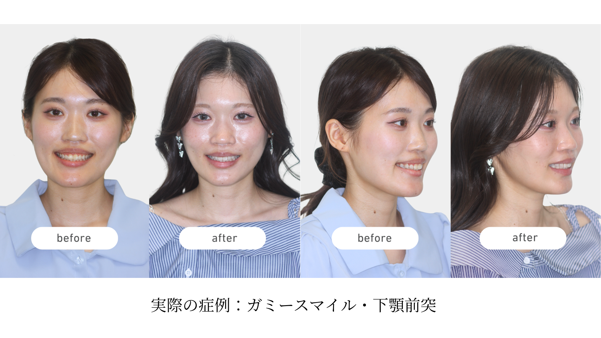 #5 両顎手術での「審美」だけを追う危うさ